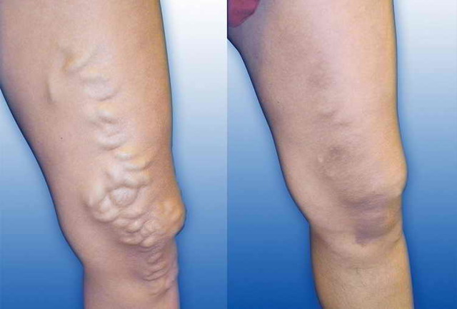 Лимфодренаж: что это такое и его виды