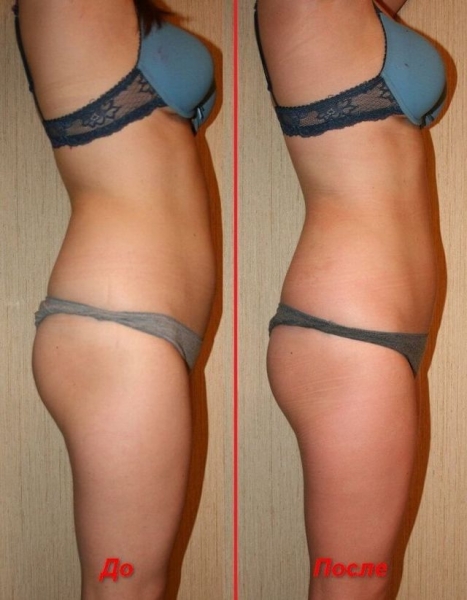 Лимфодренаж в домашних условиях (щеткой, аппаратный, ручной) – показания и противопоказания для массажа рук, ног, лица