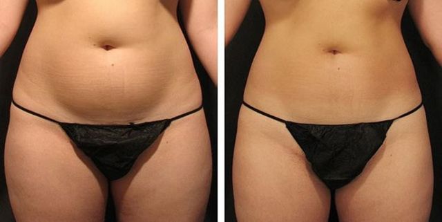 Лимфодренаж в домашних условиях (щеткой, аппаратный, ручной) – показания и противопоказания для массажа рук, ног, лица