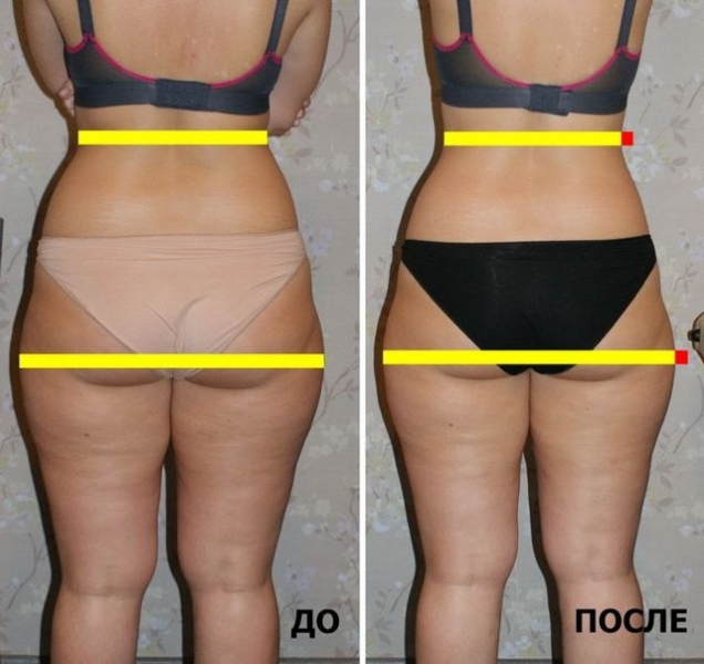 Лимфодренаж в домашних условиях (щеткой, аппаратный, ручной) – показания и противопоказания для массажа рук, ног, лица