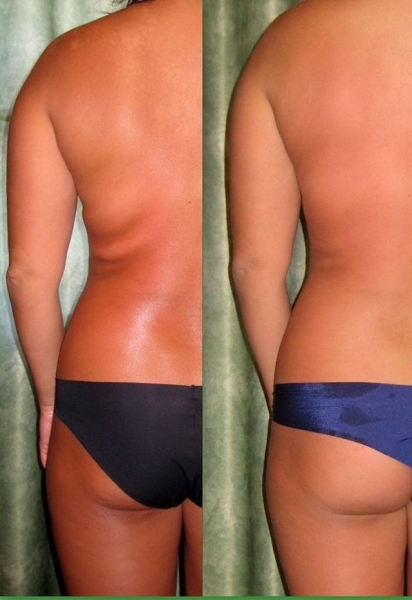 Лимфодренаж в домашних условиях (щеткой, аппаратный, ручной) – показания и противопоказания для массажа рук, ног, лица