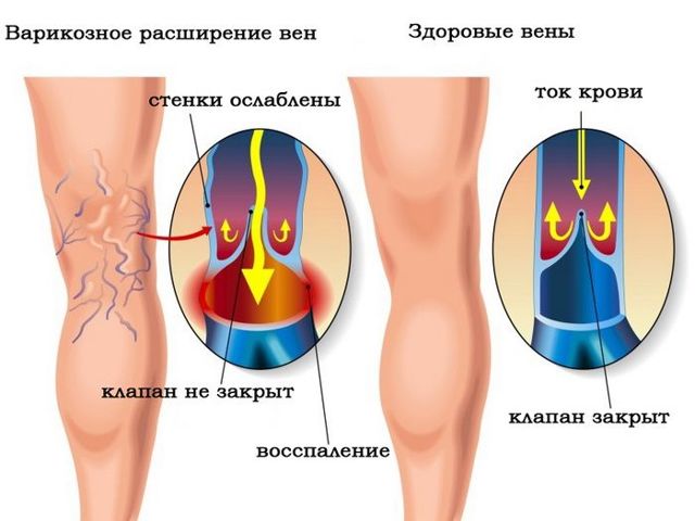 Лимфодренаж в домашних условиях (щеткой, аппаратный, ручной) – показания и противопоказания для массажа рук, ног, лица