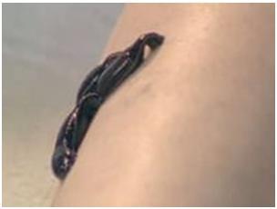 Лимфостаз: лечение (народное, гирудотерапия), причины