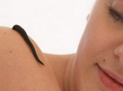 Лимфостаз: лечение (народное, гирудотерапия), причины