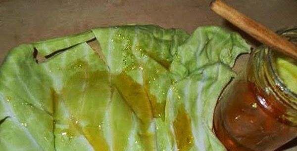 Лимфостаз: лечение (народное, гирудотерапия), причины