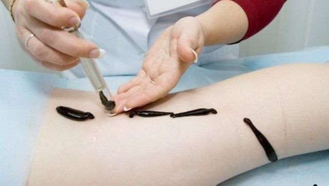 Лимфостаз: лечение (народное, гирудотерапия), причины