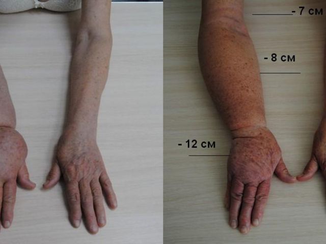 Лимфостаз руки: лечение (диеты, народные методы), причины, диагностика