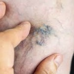 Лиотон и венолайф: что лучше и в чем разница (отличие составов, отзывы врачей)