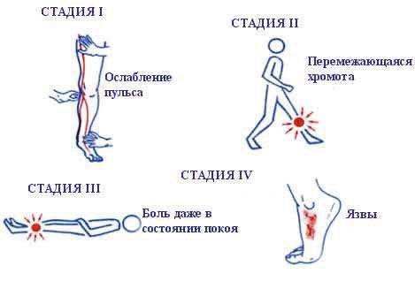 Можно ли ездить на велосипеде при варикозе