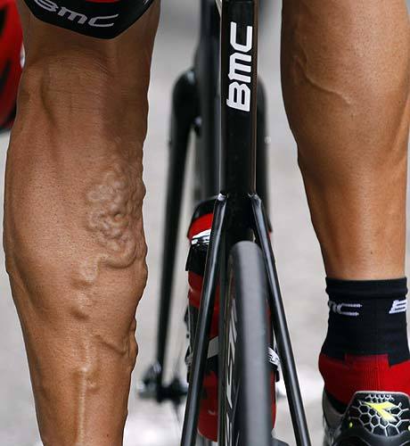 Можно ли ездить на велосипеде при варикозе