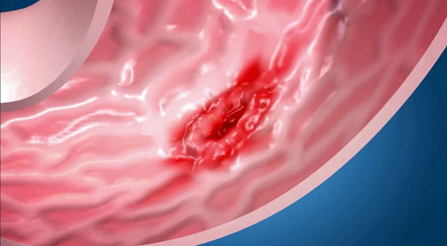 Можно ли откосить от армии с гастритом: хронический, гастродуоденит, холецистит, берут ли с недовесом