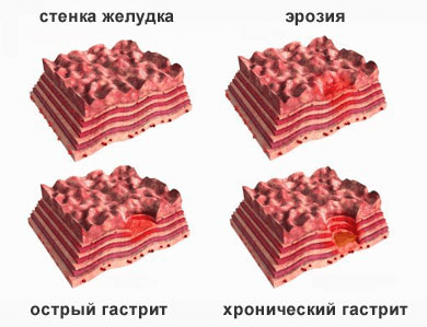Можно ли откосить от армии с гастритом: хронический, гастродуоденит, холецистит, берут ли с недовесом