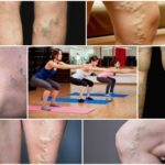 Можно ли приседать при варикозе