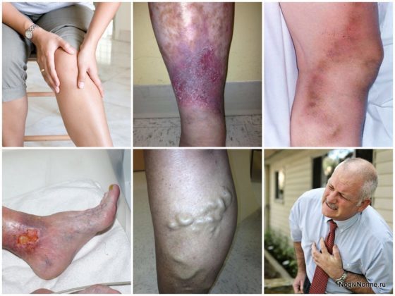 Можно ли приседать при варикозе