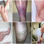 Можно ли приседать при варикозе