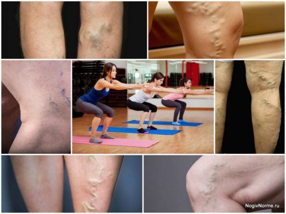 Можно ли приседать при варикозе