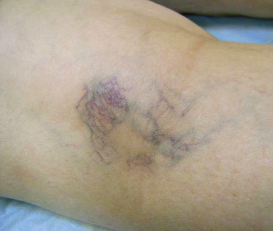 Можно ли прыгать на скакалке при варикозе