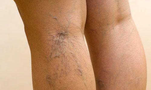 Начальная стадия варикоза на ногах: способы лечения и как распознать (симптомы, диагностика)