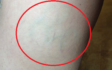 Начальная стадия варикоза на ногах: способы лечения и как распознать (симптомы, диагностика)