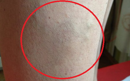 Начальная стадия варикоза на ногах: способы лечения и как распознать (симптомы, диагностика)