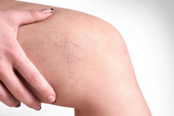 Начальная стадия варикоза на ногах: способы лечения и как распознать (симптомы, диагностика)