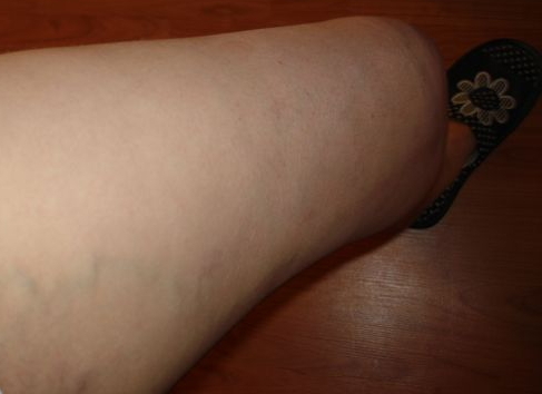 Начальная стадия варикоза на ногах: способы лечения и как распознать (симптомы, диагностика)