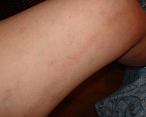 Начальная стадия варикоза на ногах: способы лечения и как распознать (симптомы, диагностика)