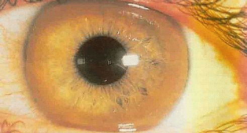 Нехватка меди в организме