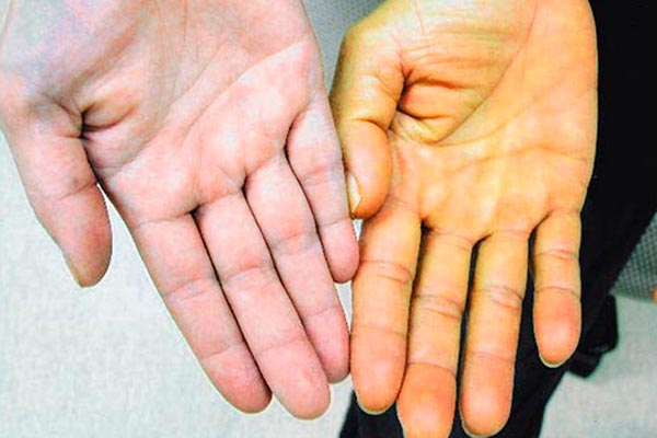 Нехватка витамина а симптомы у взрослых