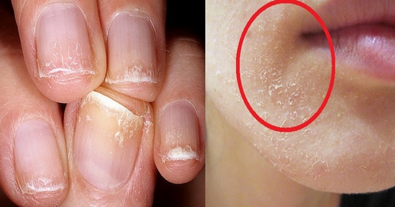 Нехватка витамина а симптомы у взрослых