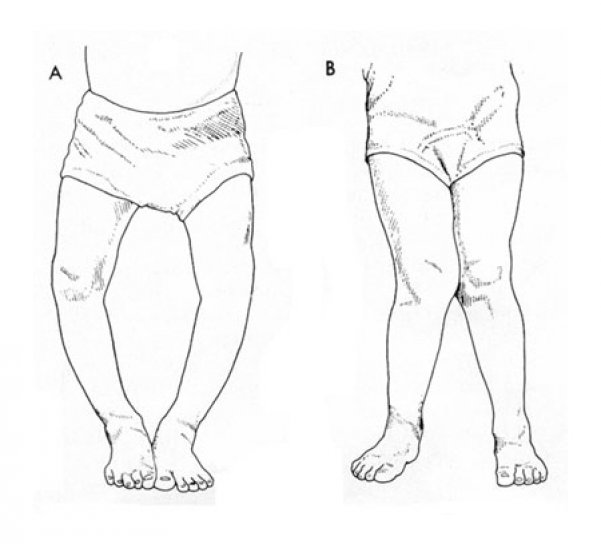 Нехватка витамина д у ребенка