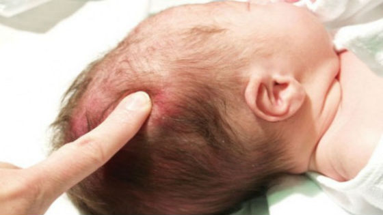 Нехватка витамина д у ребенка