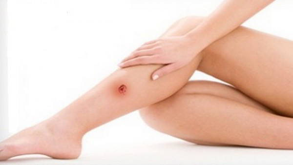 Обезболивающие при трофических язвах