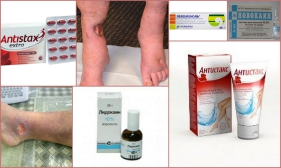 Обезболивающие при трофических язвах
