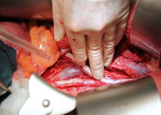 Операция мармара при варикоцеле: показания и противопоказания, преимущества и недостатки, техника проведения, осложнения, стоимость