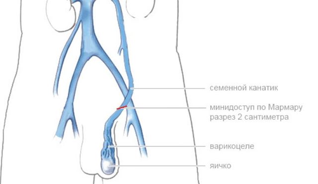 Операция мармара при варикоцеле: показания и противопоказания, преимущества и недостатки, техника проведения, осложнения, стоимость