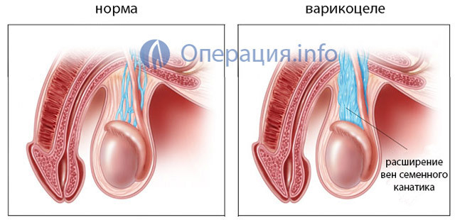 Операция мармара при варикоцеле: показания и противопоказания, преимущества и недостатки, техника проведения, осложнения, стоимость