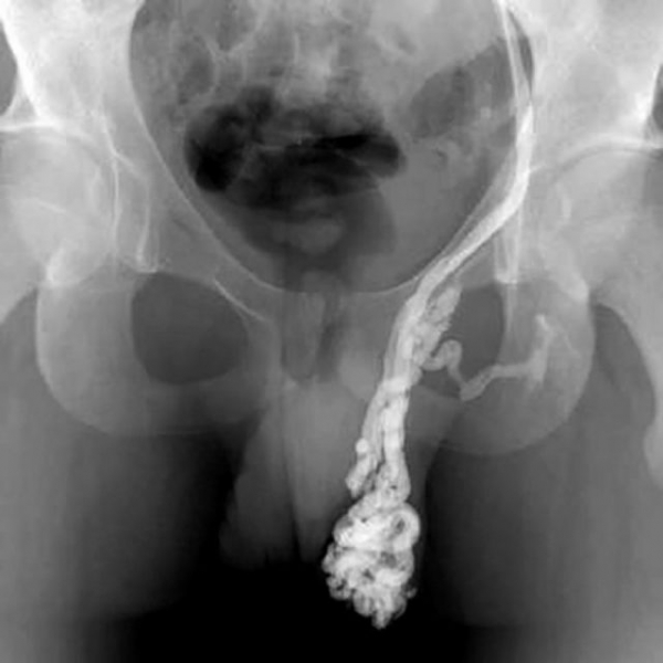 Операция мармара при варикоцеле: показания и противопоказания, преимущества и недостатки, техника проведения, осложнения, стоимость