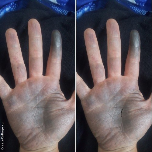 Остров на линии жизни: правая и левая рука, большой остров — что означает