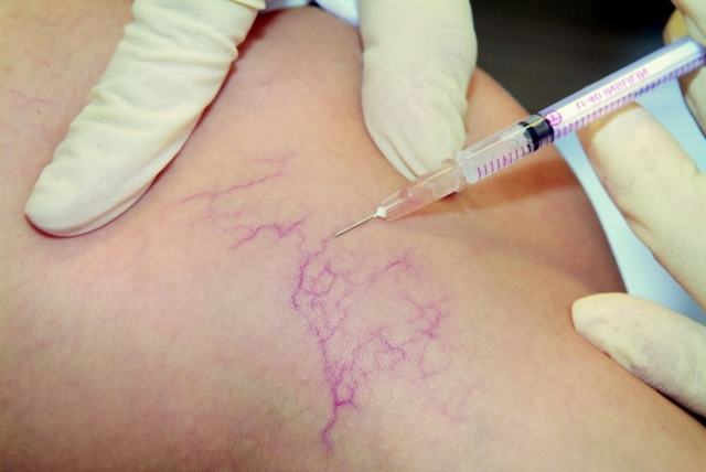 Отеки при варикозе: причины, лечение (народные средства, медикаменты, эфирные масла), профилактика (упражнения, компрессионное белье)