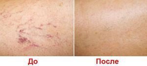 Отеки при варикозе: причины, лечение (народные средства, медикаменты, эфирные масла), профилактика (упражнения, компрессионное белье)