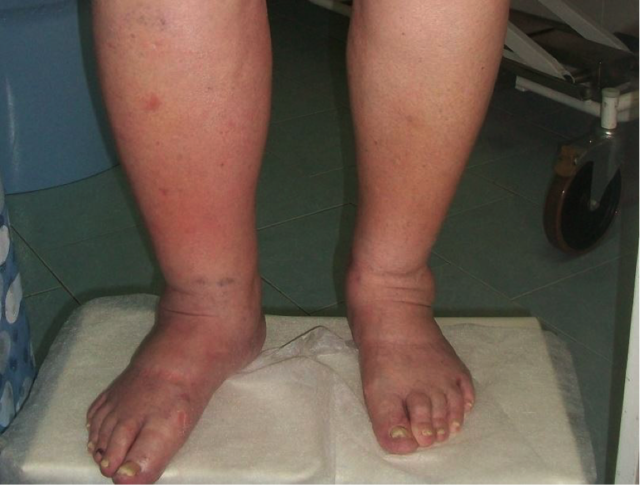 Отеки при варикозе: причины, лечение (народные средства, медикаменты, эфирные масла), профилактика (упражнения, компрессионное белье)