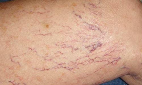 Пентоксифиллин и винпоцетин: что лучше и в чем разница (отличие составов, отзывы врачей)