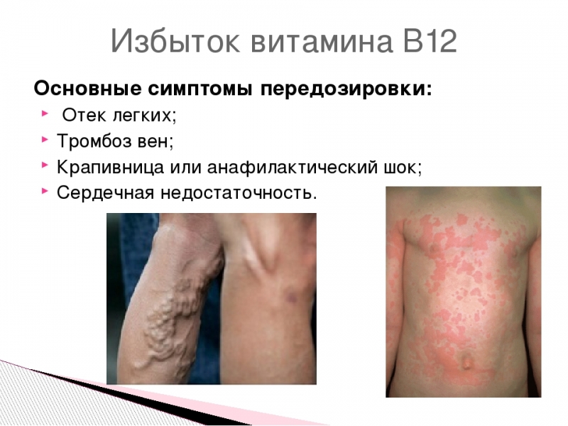 Передозировка витамина в12 симптомы