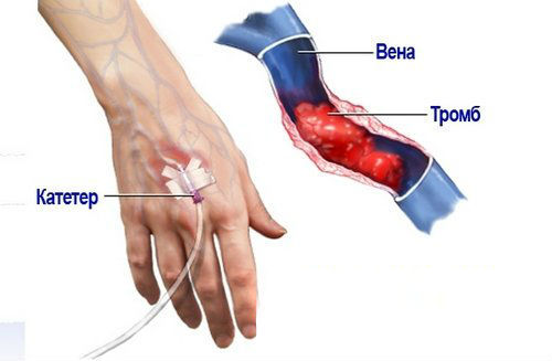 Постинъекционный флебит: лечение