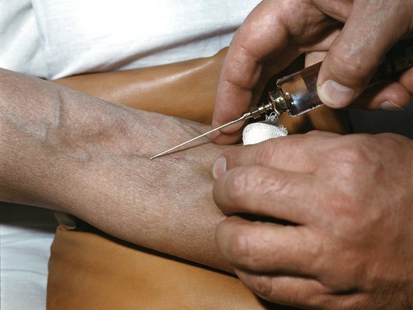 Постинъекционный флебит: лечение