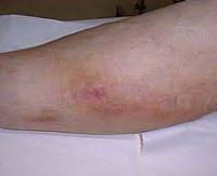 Постинъекционный флебит: лечение