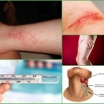 Постинъекционный флебит: лечение