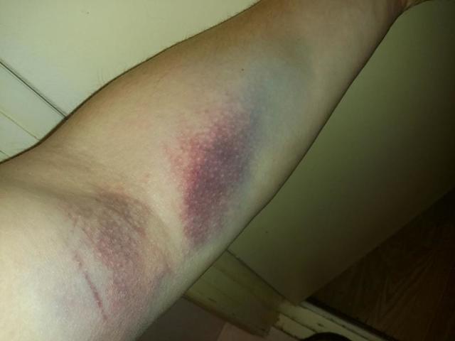 Постинъекционный флебит: лечение