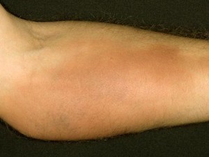 Постинъекционный флебит: лечение